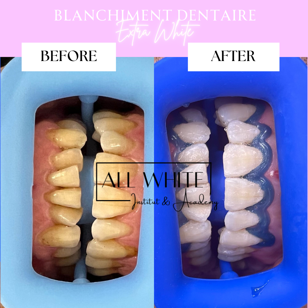 Blanchiment Extra white