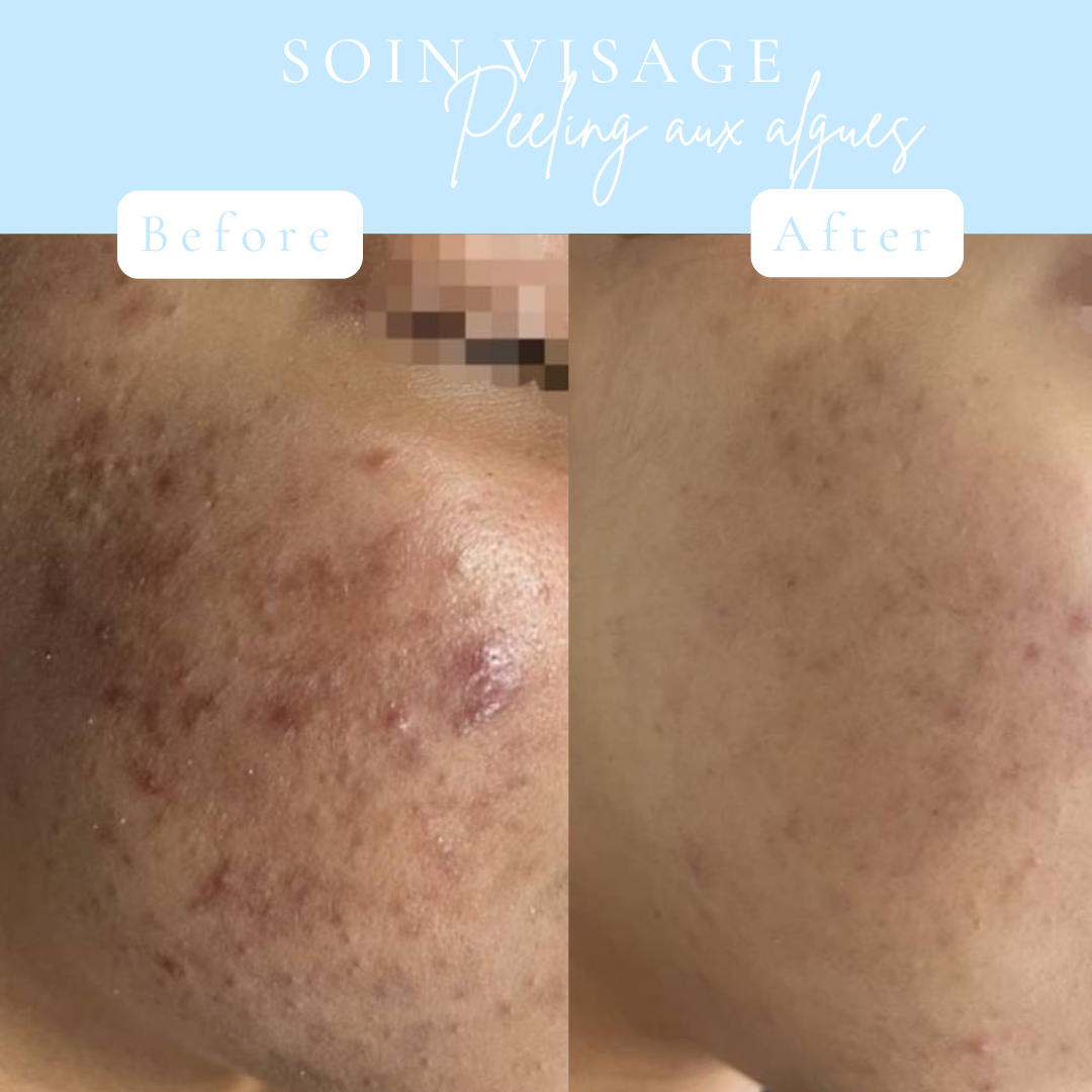 Soin peeling aux algues